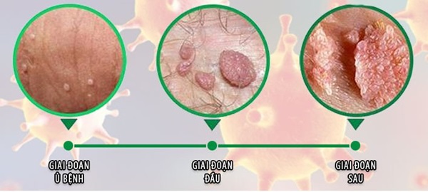 biểu hiện sùi mào gà