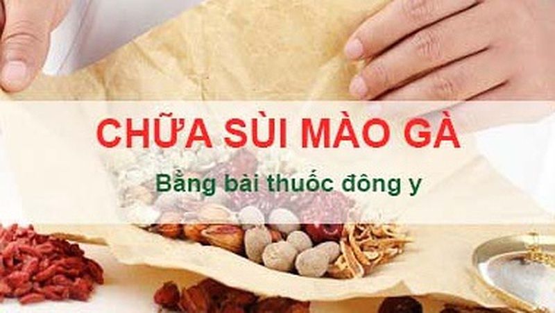 Bài thuốc uống chữa sùi mào gà